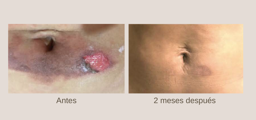 Eficacia comprobada del aceite de cacay