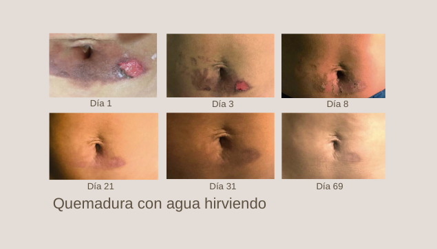 Aceite de Cacay para tratar quemaduras